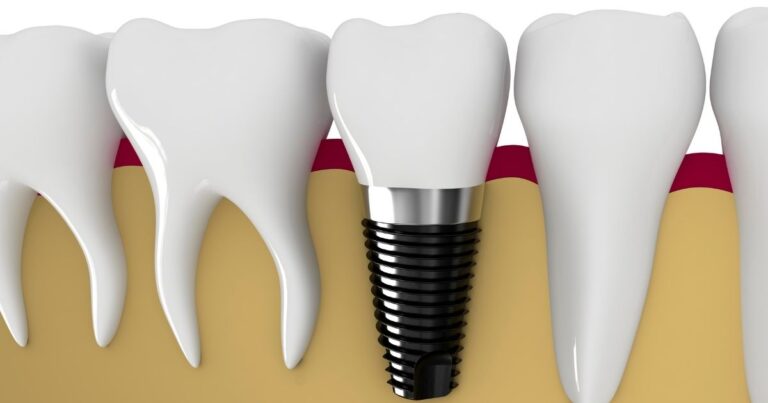 Is a Loose Dental Implant an Emergency?